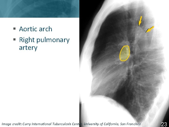 § Aortic arch § Right pulmonary artery Image Tuberculosis Center, University of California, San
