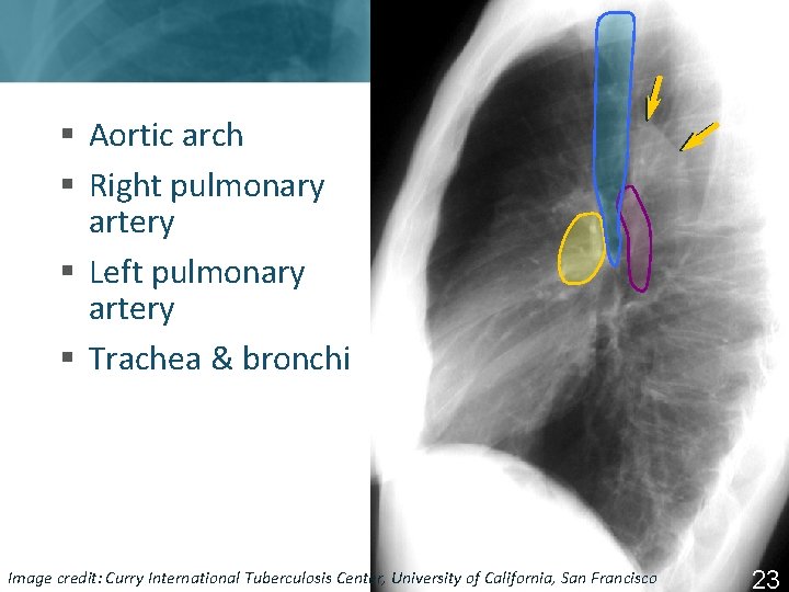 § Aortic arch § Right pulmonary artery § Left pulmonary artery § Trachea &