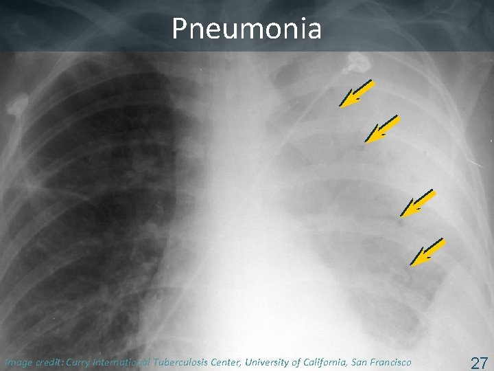 Pneumonia Image Tuberculosis Center, University of California, San Francisco ISTC TBcredit: Training Curry Modules.