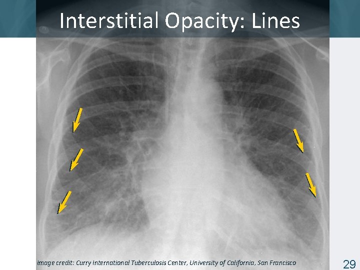 Interstitial Opacity: Lines Image credit: Curry International Tuberculosis Center, University of California, San Francisco