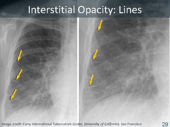 Interstitial Opacity: Lines Image Tuberculosis Center, University of California, San Francisco ISTC TBcredit: Training