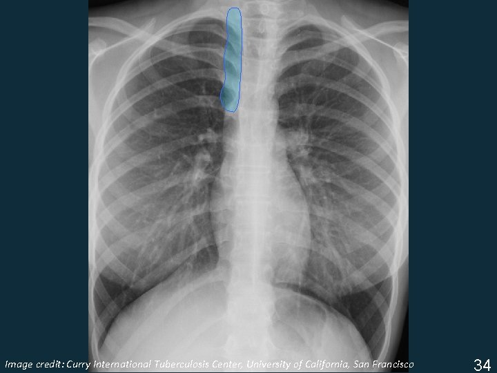 Image Tuberculosis Center, University of California, San Francisco ISTC TBcredit: Training Curry Modules. International