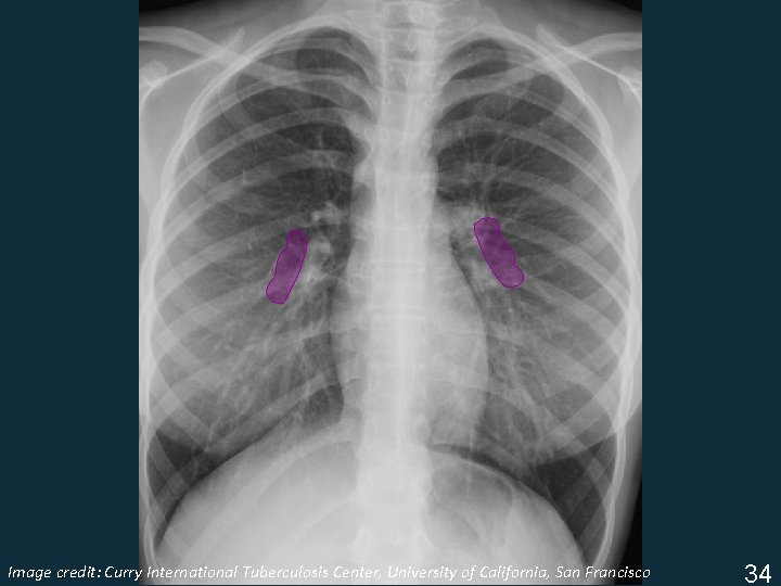 Image Tuberculosis Center, University of California, San Francisco ISTC TBcredit: Training Curry Modules. International