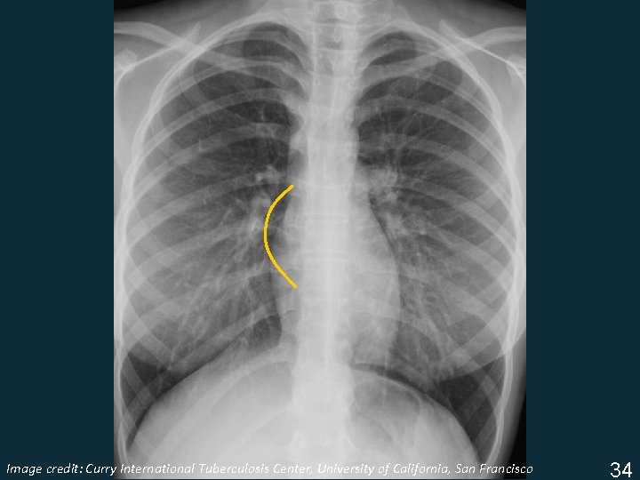 Image Tuberculosis Center, University of California, San Francisco ISTC TBcredit: Training Curry Modules. International