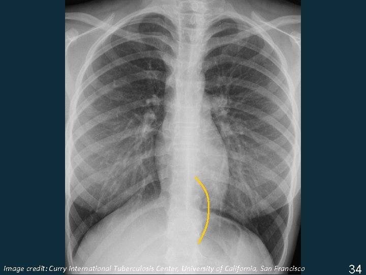 Image Tuberculosis Center, University of California, San Francisco ISTC TBcredit: Training Curry Modules. International