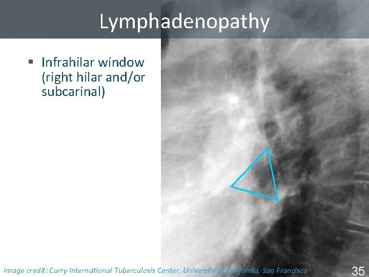 Lymphadenopathy § Infrahilar window (right hilar and/or subcarinal) Image Tuberculosis Center, University of California,