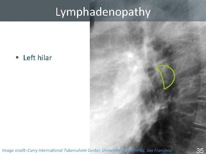 Lymphadenopathy § Left hilar Image Tuberculosis Center, University of California, San Francisco ISTC TBcredit: