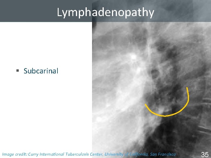 Lymphadenopathy § Subcarinal Image Tuberculosis Center, University of California, San Francisco ISTC TBcredit: Training