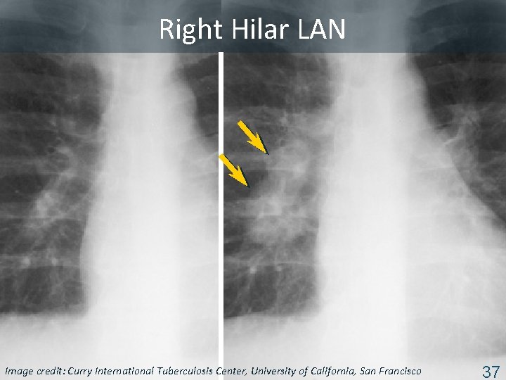 Right Hilar LAN Image Tuberculosis Center, University of California, San Francisco ISTC TBcredit: Training