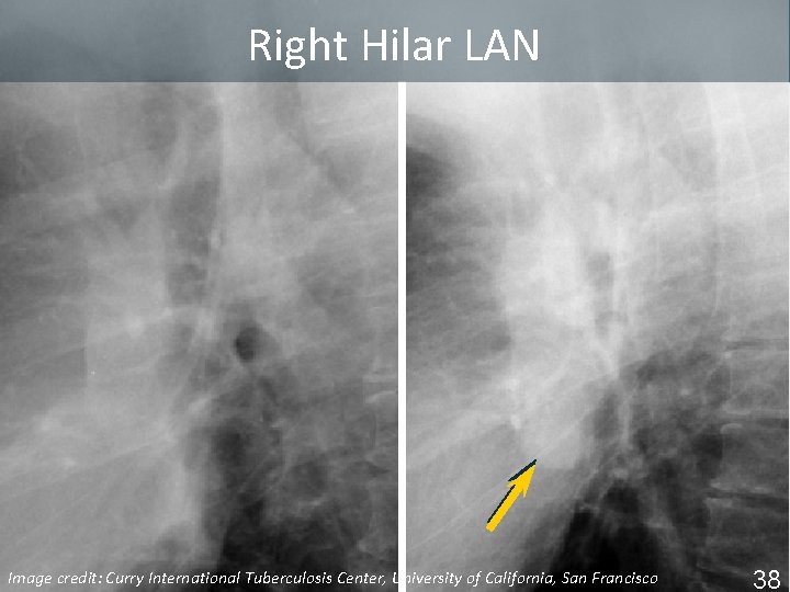 Right Hilar LAN Image Tuberculosis Center, University of California, San Francisco ISTC TBcredit: Training
