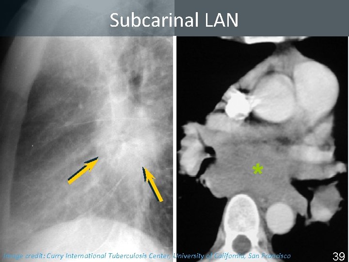 Subcarinal LAN * Image Tuberculosis Center, University of California, San Francisco ISTC TBcredit: Training