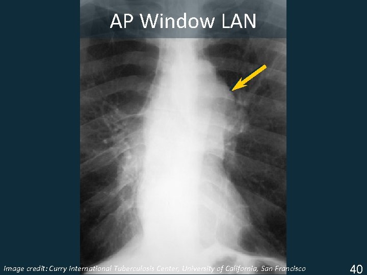 AP Window LAN Image Tuberculosis Center, University of California, San Francisco ISTC TBcredit: Training