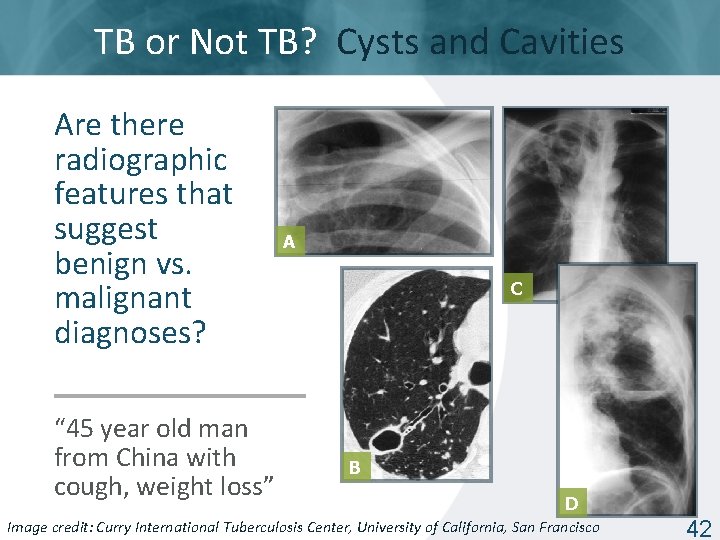 TB or Not TB? Cysts and Cavities Are there radiographic features that suggest benign