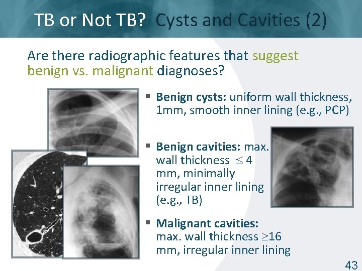 TB or Not TB? Cysts and Cavities (2) Are there radiographic features that suggest