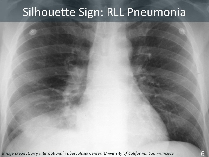 Silhouette. Sign: RLL Pneumonia Silhouette Pneumonia Image Tuberculosis Center, University of California, San Francisco