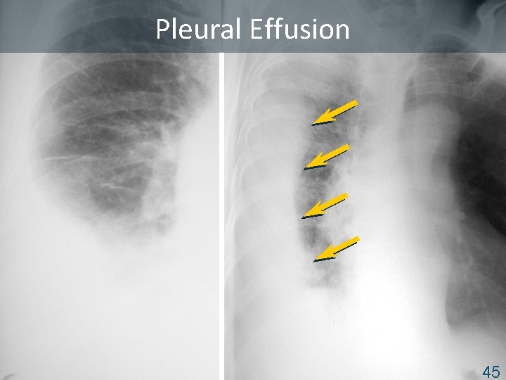 Pleural Effusion ISTC TB Training Modules 2009 45 