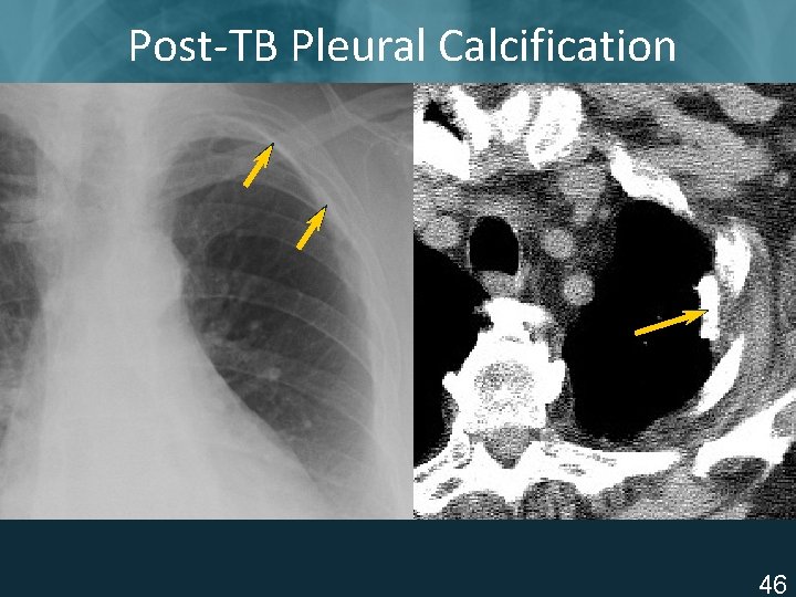 Post-TB Pleural Calcification ISTC TB Training Modules 2009 46 