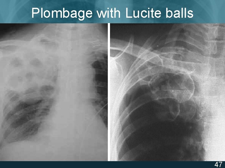 Plombage with Lucite balls ISTC TB Training Modules 2009 47 