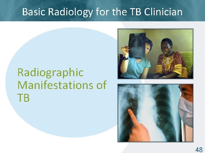 Basic Radiology for the TB Clinician Radiographic Manifestations of TB ISTC TB Training Modules