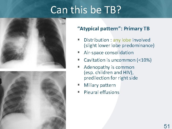 Can this be TB? “Atypical pattern”: Primary TB § Distribution : any lobe involved