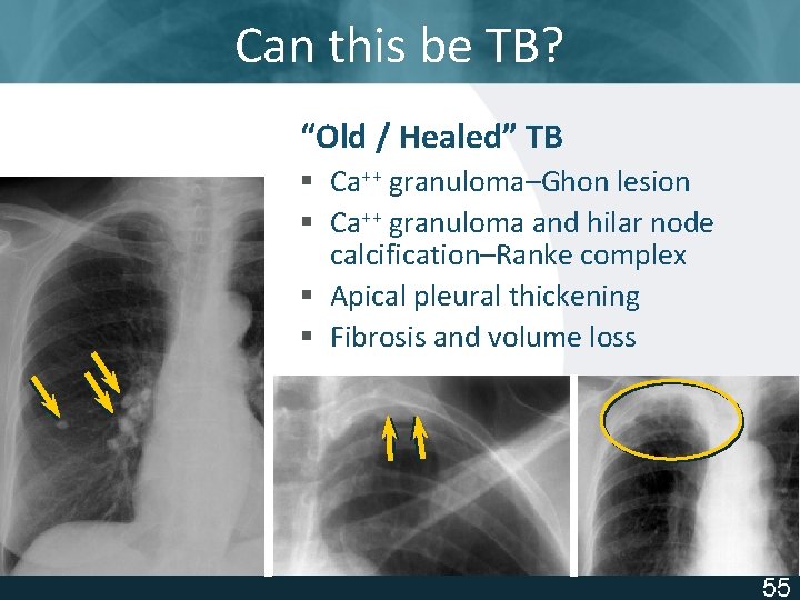 Can this be TB? “Old / Healed” TB § Ca++ granuloma–Ghon lesion § Ca++
