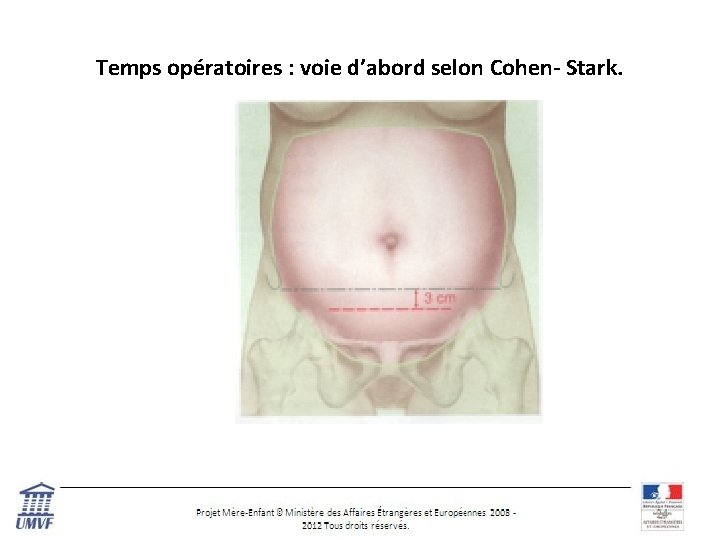 Temps opératoires : voie d’abord selon Cohen- Stark. 