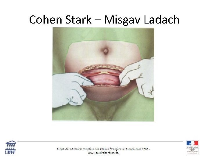 Cohen Stark – Misgav Ladach 