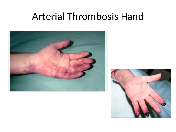 Arterial Thrombosis Hand 