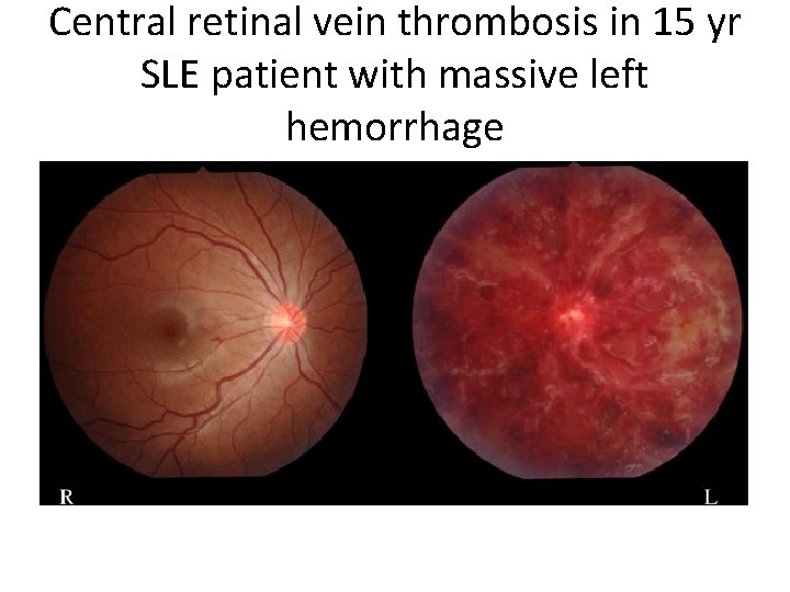 Central retinal vein thrombosis in 15 yr SLE patient with massive left hemorrhage 