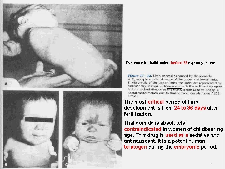 Exposure to thalidomide before 33 day may cause The most critical period of limb