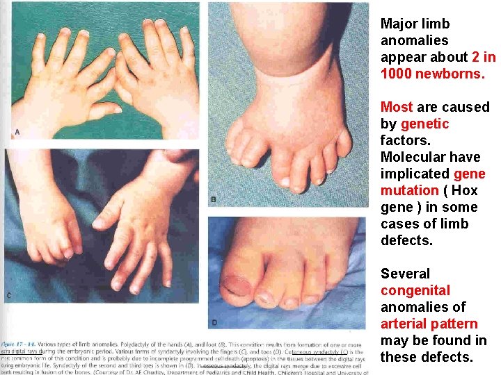 Major limb anomalies appear about 2 in 1000 newborns. Most are caused by genetic