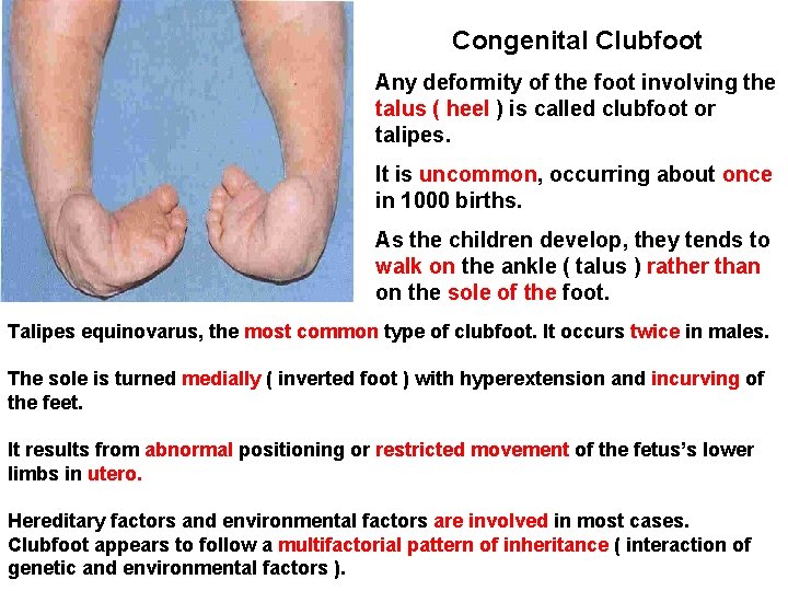 Congenital Clubfoot Any deformity of the foot involving the talus ( heel ) is
