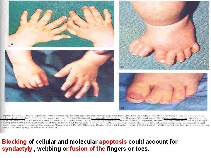 Blocking of cellular and molecular apoptosis could account for syndactyly , webbing or fusion