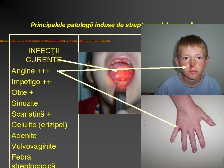 Principalele patologii induse de streptococul de grup A INFECŢII CURENTE Angine +++ Impetigo ++