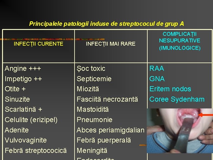 Principalele patologii induse de streptococul de grup A INFECŢII CURENTE Angine +++ Impetigo ++