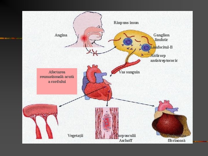Răspuns imun Angina Ganglion limfatic Limfocitul-B Anticorp antistreptococic Afectarea reumatismală acută a cordului Vegetaţii