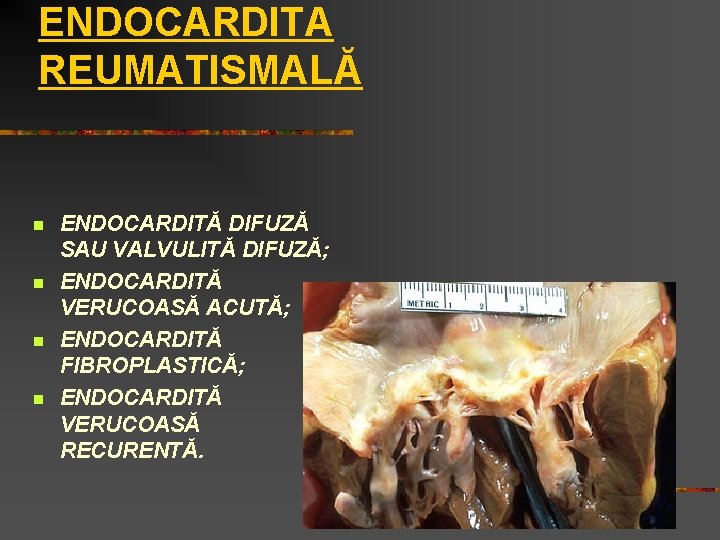 ENDOCARDITA REUMATISMALĂ n n ENDOCARDITĂ DIFUZĂ SAU VALVULITĂ DIFUZĂ; ENDOCARDITĂ VERUCOASĂ ACUTĂ; ENDOCARDITĂ FIBROPLASTICĂ;