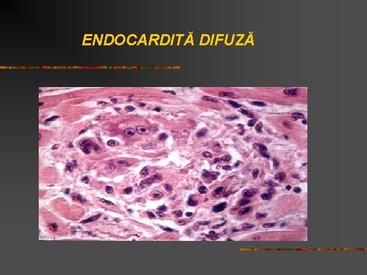 ENDOCARDITĂ DIFUZĂ 