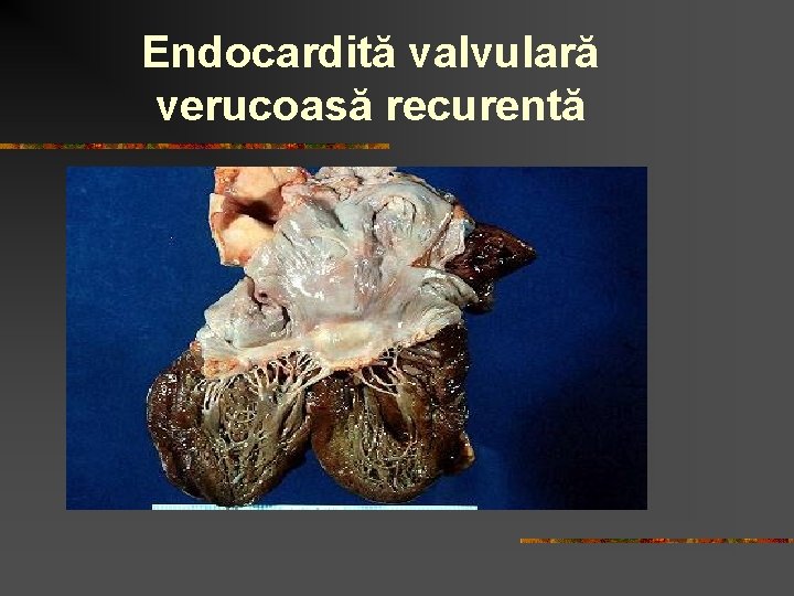 Endocardită valvulară verucoasă recurentă 