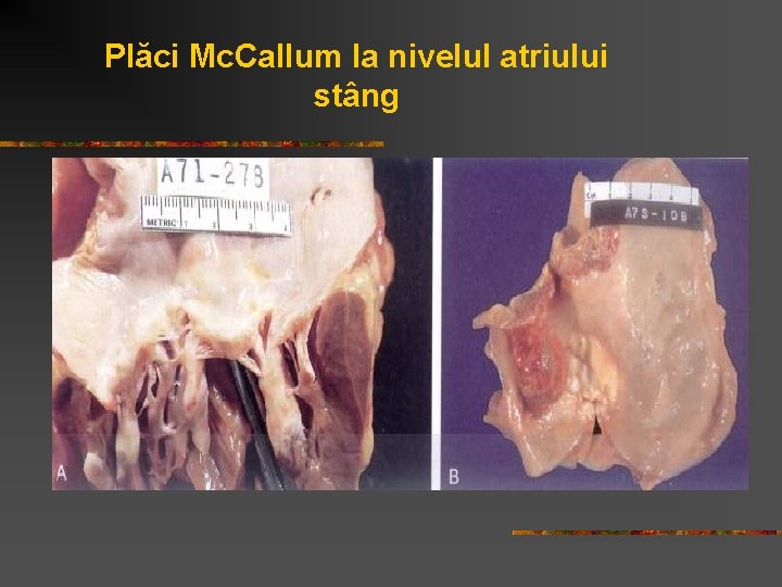 Plăci Mc. Callum la nivelul atriului stâng 