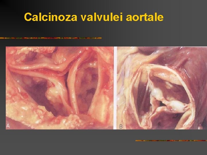 Calcinoza valvulei aortale 
