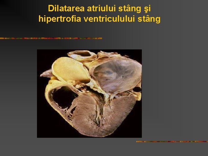 Dilatarea atriului stâng şi hipertrofia ventriculului stâng 