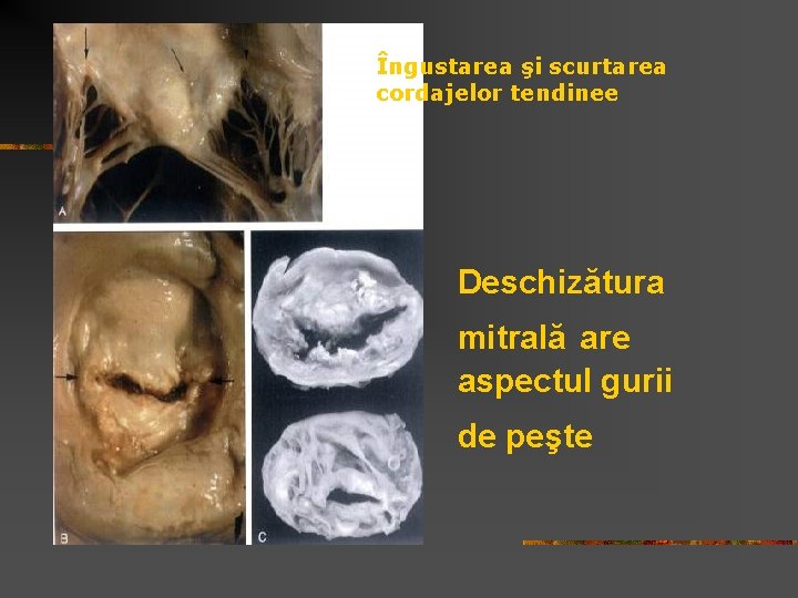 Îngustarea şi scurtarea cordajelor tendinee Deschizătura mitrală are aspectul gurii de peşte 