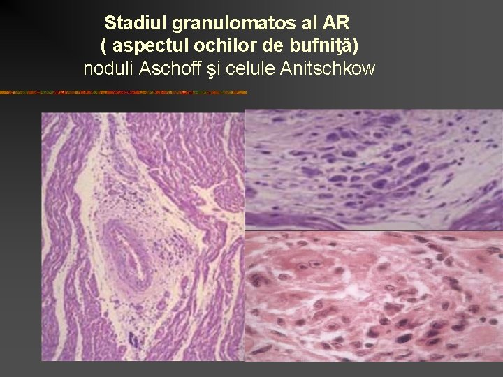 Stadiul granulomatos al AR ( aspectul ochilor de bufniţă) noduli Aschoff şi celule Anitschkow