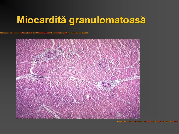 Miocardită granulomatoasă 