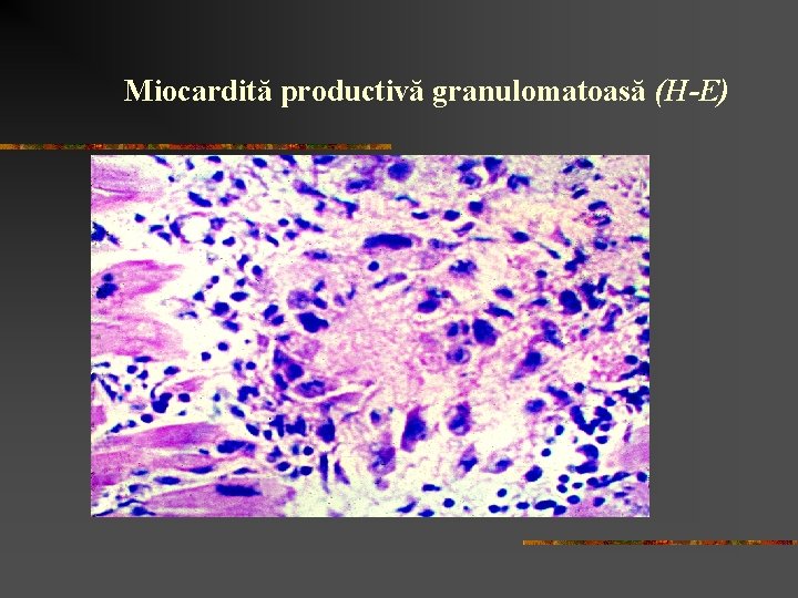 Miocardită productivă granulomatoasă (H-E) 