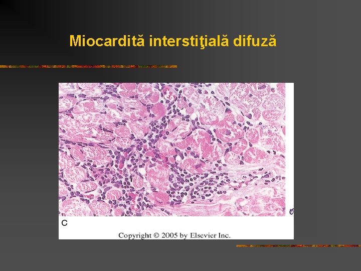 Miocardită interstiţială difuză 