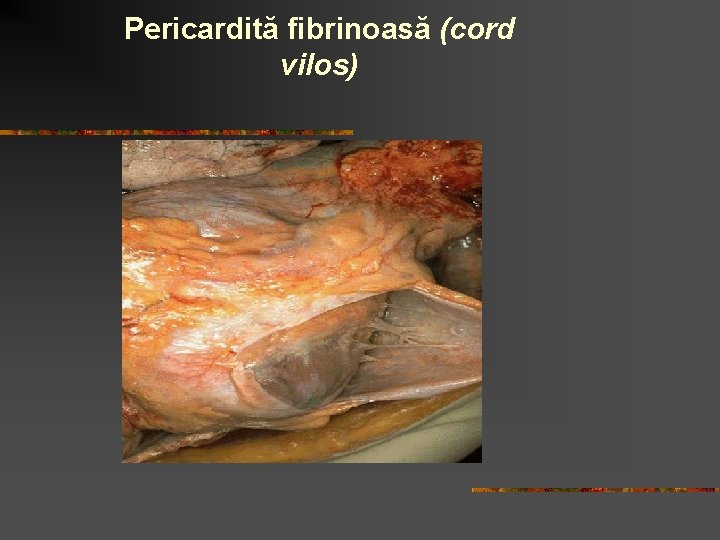 Pericardită fibrinoasă (cord vilos) 