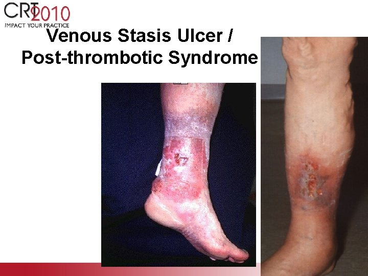 Venous Stasis Ulcer / Post-thrombotic Syndrome 