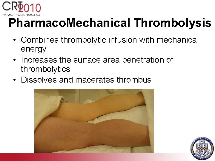 Pharmaco. Mechanical Thrombolysis • Combines thrombolytic infusion with mechanical energy • Increases the surface